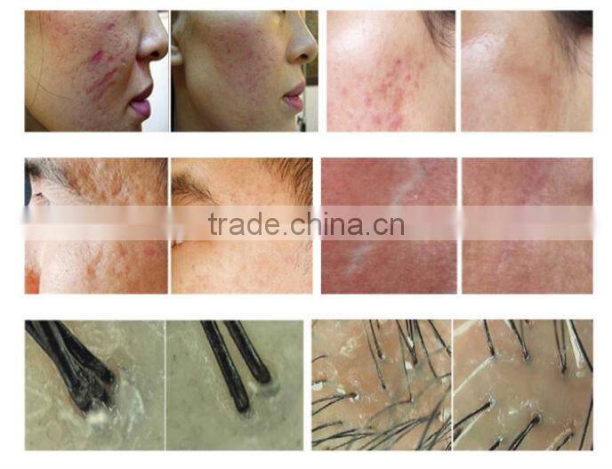 GTO brand collection hot sales derma roller 200/540/600/1080 with CE approved with whole sales price