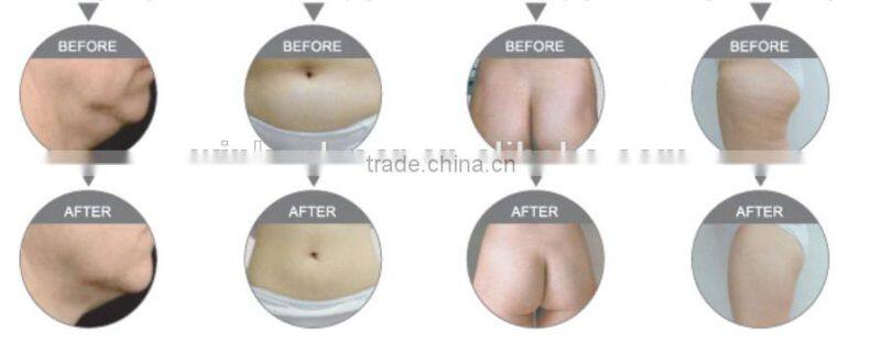 rf cavitation / cavitation rf vacuum machine / best ultrasound cavitation machine