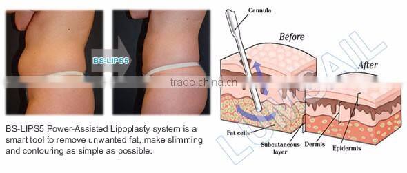 Power Assisted Surgical liposuction equipment