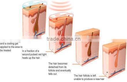 808mm diode laser hair removal /permanent hair removal machine