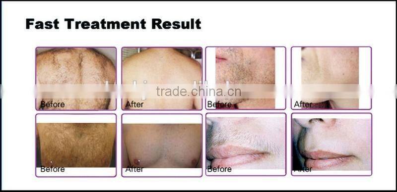 Updated laser diode 808nm diode laser machine with Itlay pump