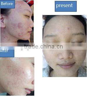 2014 Professional Oxygen Beauty System Oxy 95% Oxygen Water Oxygen Machine