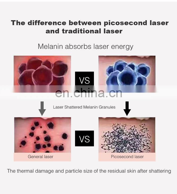 Amazing!!!Safe and Effective eliminates spots tattoo removal picosecond laser machine for sale