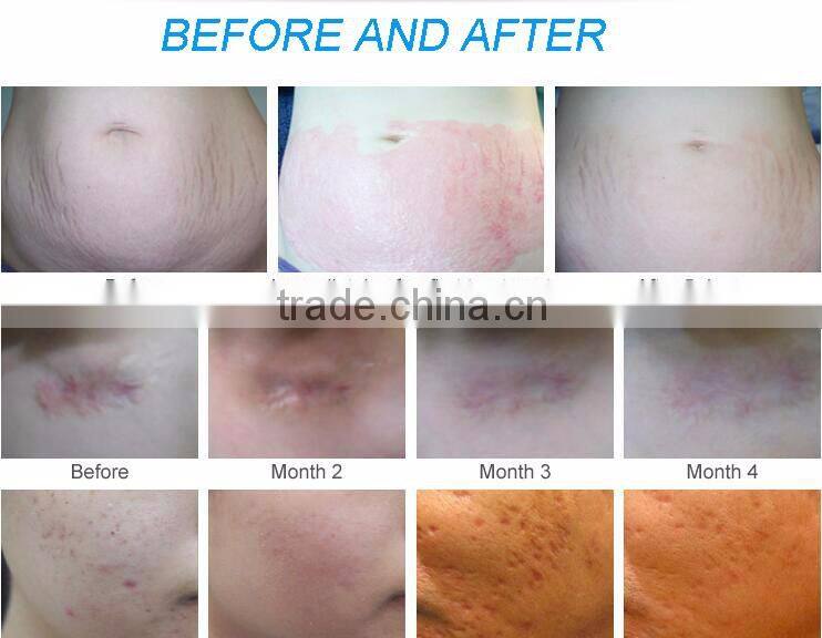 professional dermal pen derma pen electric /dermapen needles micro needle pen for sale