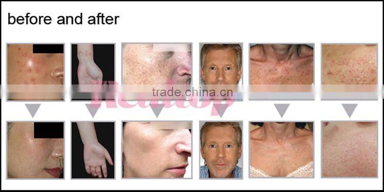 2016 Most popular made in China co2 laser fractional vaginal tightening device