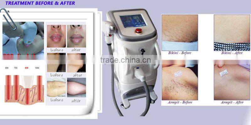 Painless 808nm diode laser hair removal
