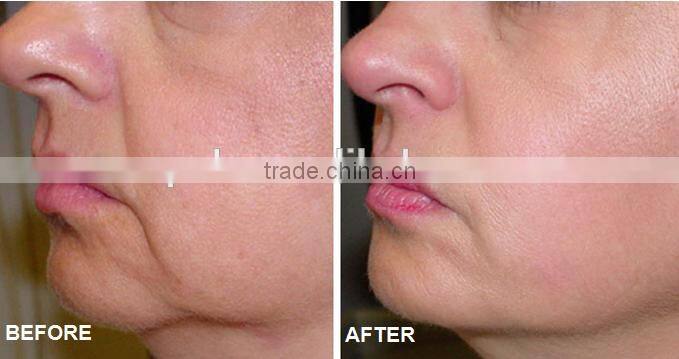 Apolomed radio frequency ceramic RF monopolar and cavitation for wrinkle and fat removal