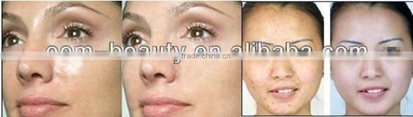 Q-switched ND: YAG laser, laser tattoo removal machine price for eyebrow removal skin rejuvenation -D003