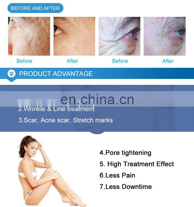 Beijing Lefis rf metal tube pore tightening machine stretch marks removal