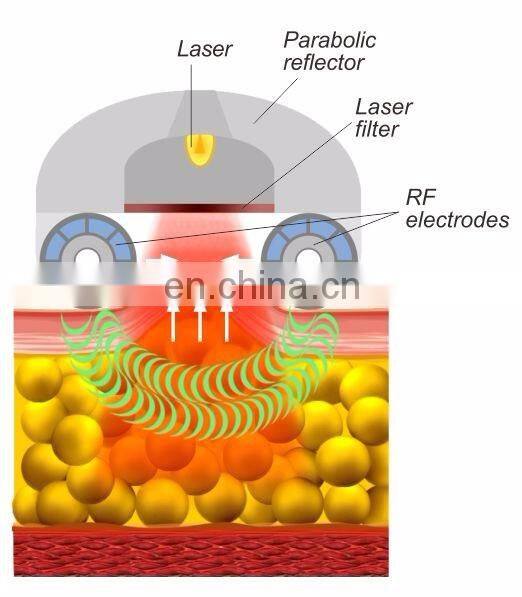 OSANO SHAPE CE approved professional vacuum cellulite radio frequency skin tightening machine