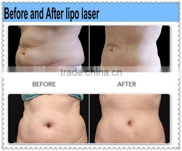 AF-S33 slimming Liposuction Laser machine lipo