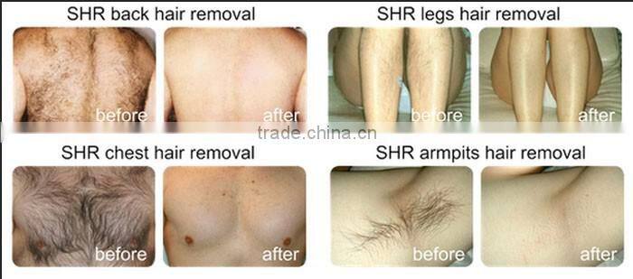 Topest OPT+Laser+Elight+RF Hair Removal For Four Functions with High Quality