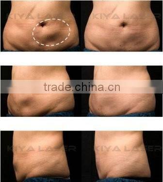 ultrasound cavitation slimming gel for cavitation