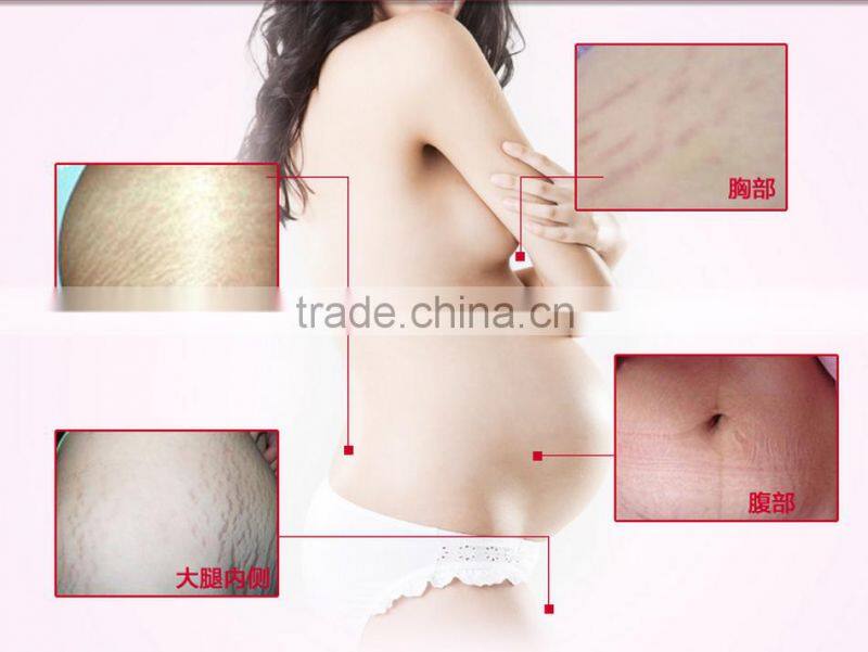 Stretch marks cream,postpartum obesity , pregnancy repairing cream, slack line,dsmv a potent repair scar products