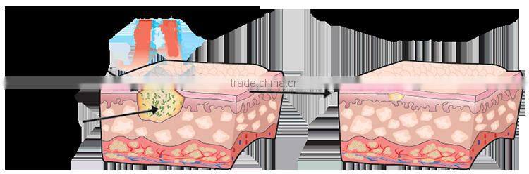 best acne treatment products LED photodynamic therapy skin care