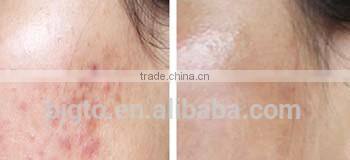 GTO 2014New GMT 540needles micro needle derma roller with blue violet head