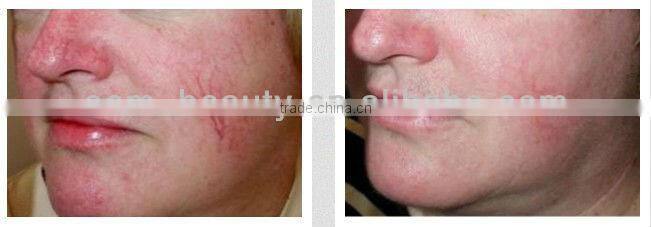 Cheapest!! microneedle roller system derma roller titanium L007