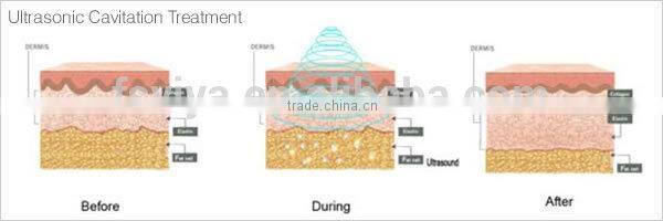 VY-QB2 cavi lipo slim lipo massage machine