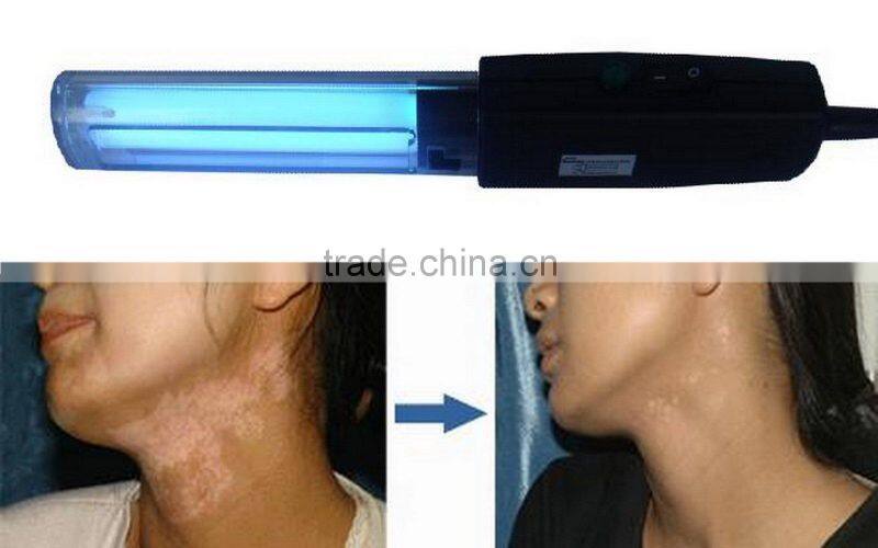 medical use clinical use house use Handhold uv lamp 311nm for vitiligo