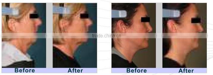 our company want distributor F2 ultra lift hifu