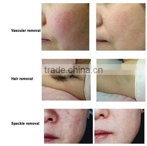 Portable professional IPL hair removal machine distributors wanted