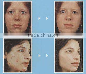 Popular PDT/LED skin rejuvenation machine G004