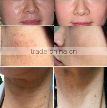 Microneedles BIO 540 needle derma roller with replaceable head cts-540