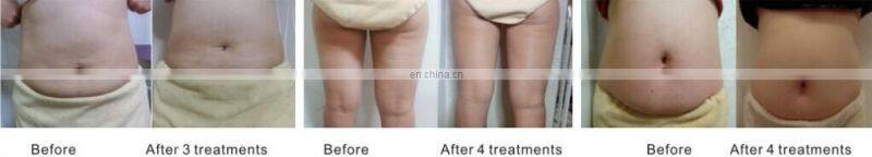 Best slimming products/ultrasonic cavitation rf slimming device