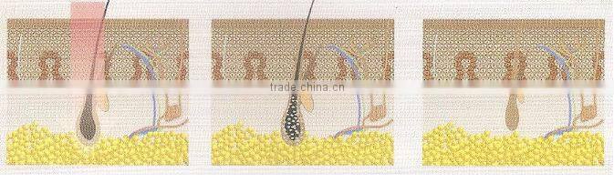 Y8A Merry Christmas 20% OFF 808nm diode laser painless hair removal machine