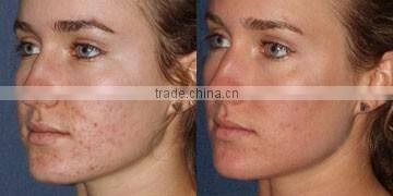 Skin Tightening manufacturer Skin Tightening fractional co2 laser equipment, co2 laser scar removal Acne Treatment