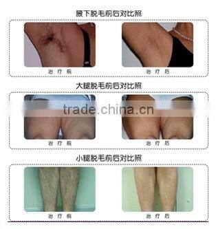 China Professional depilation diode laser hair removal machine with reasonalbe price