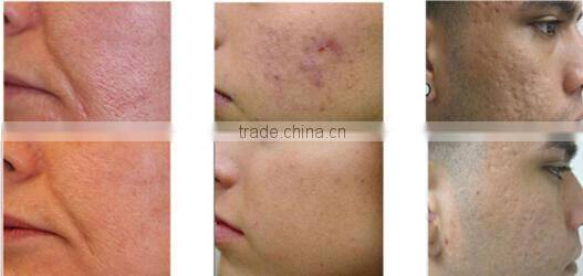 vertical 40.68mhz bipolar rf radio frequency beauty treatment equipment