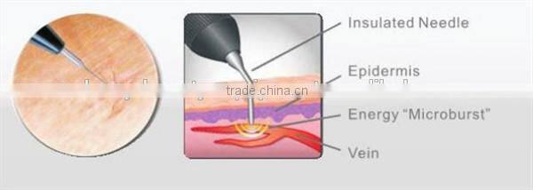 Advanced medical CE rbs spider vein removal/ vascular vein removal machine