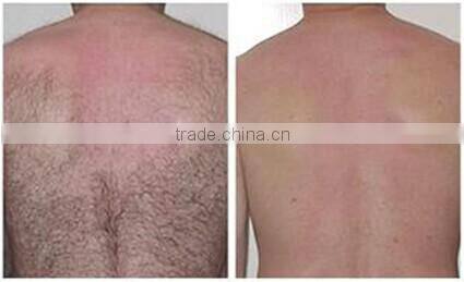 2016 Advanced beaury clinic use ipl laser hair removal machine price