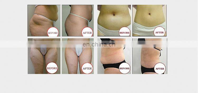 Hot sale Lipo Ultrasonic Cavitation Cryolipolysis Slimming weight loss Machine
