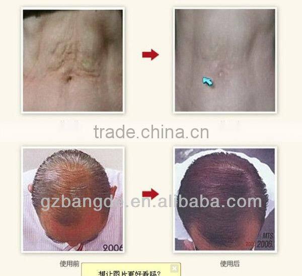 Handheld electric microneedle therapy machine BD-WZ001