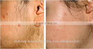 1800W Big Power 3 Functions Skin Tightening Blood Vessel Remove Laser Medical Beauty Equipment IPL Lamp