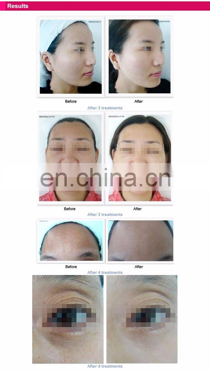 deess hot sale rf wrinkle removal skin care device rejuvenation beauty machine