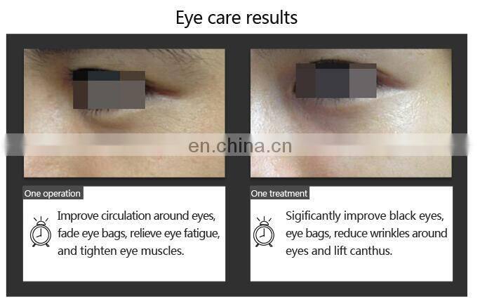 Effective home use device fine lines care eye bag remove slim face ems face lifting device mole removal cream