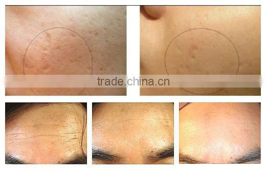 Wholesale 192 needles Titanium micro needle ZGTS derma roller system derma rolling