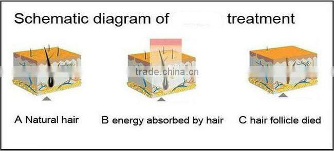 2015 Latest SHR Hair Removal Laser SHR Machine Best Selling Hot Chinese ProductsCE/ISO
