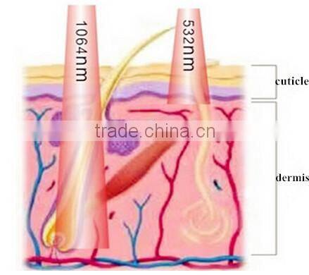 Vertical Q Switched Nd Yag Laser for all Color Tattoo Laser Removal Machine