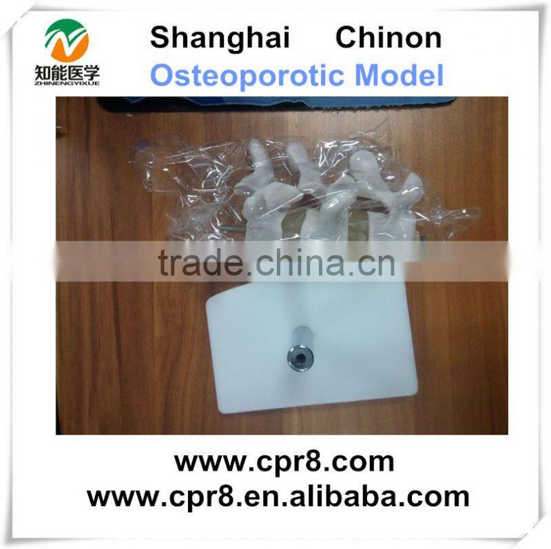 BIX-A1015 Human osteoporosis anatomical Model (3 vertebrae)