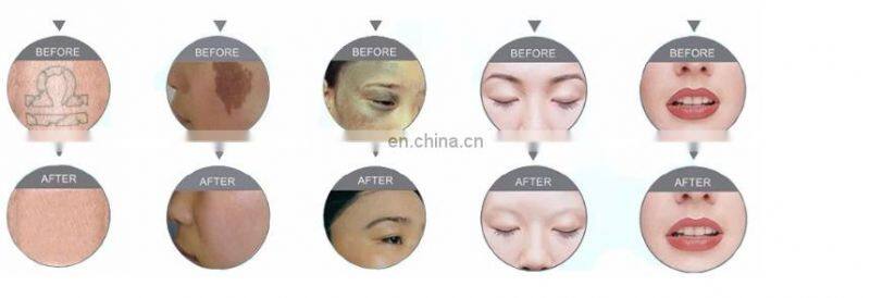 NEWEST home Yag Laser tattoo removal system/professional beauty salon used tatoo remover