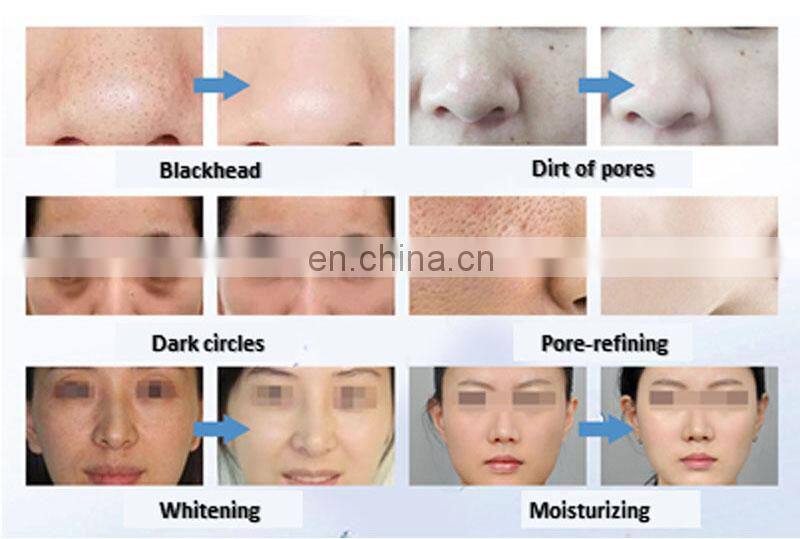 Professional skin rejuvenatian oxygen facial brush peeling rf face lifting diamond dermabrasion machine