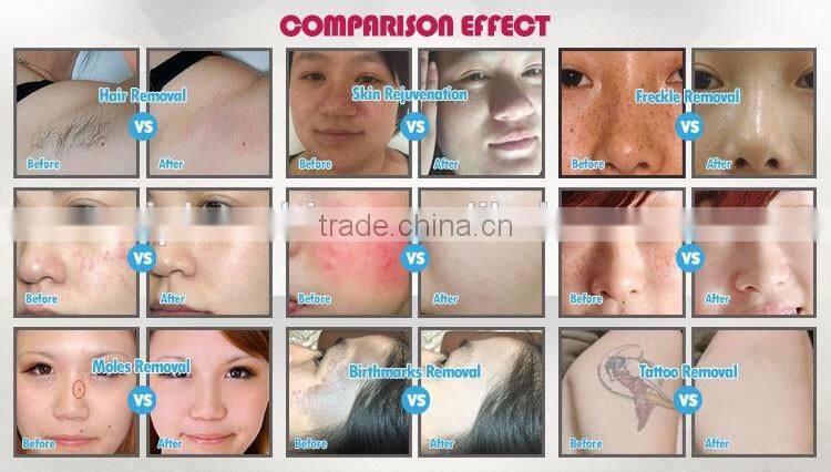 Advanced nd yag ipl multifunction beauty machine