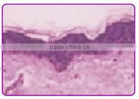 Home use radio frequency treatment