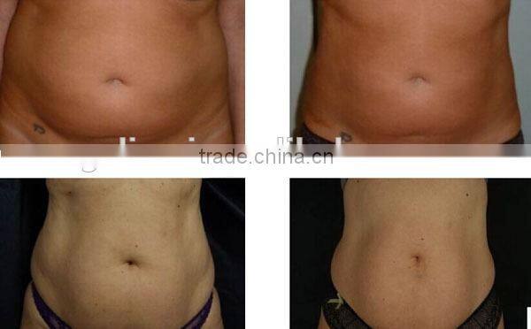 best vacuum ultrasound machine/ultrasonic cavitation vacuum slimming equipment