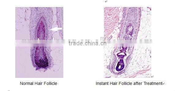 Most popular diode laser hair removal/ laser diode 808nm hair removal
