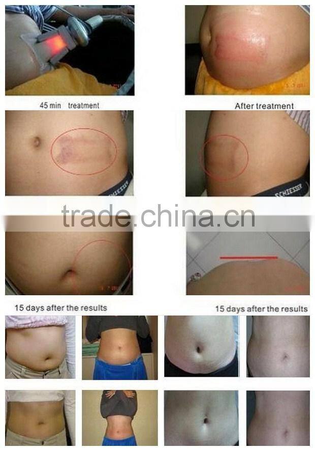 Mini Vacuum and RF Beauty Salon Equipment